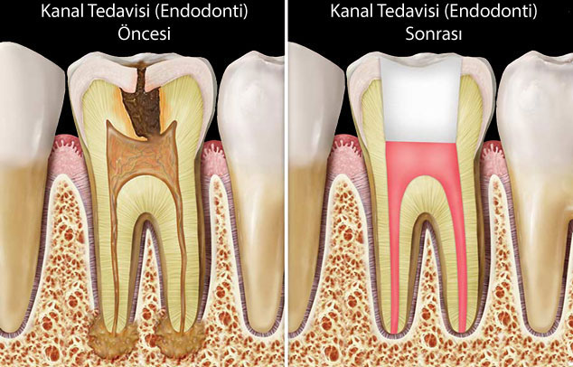 Kanal Tedavisi (Endodonti)